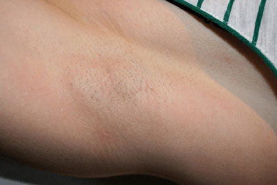 ازالة الشعر بالليزر