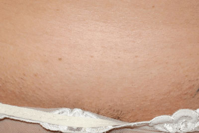 ازالة الشعر بالليزر