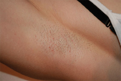 ازالة الشعر بالليزر