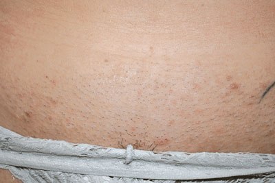 ازالة الشعر بالليزر