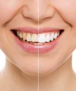 عروض تبييض الاسنان