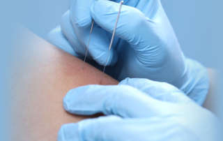 الابر الجافة