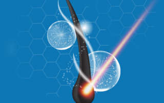 ازالة الشعر باليزر